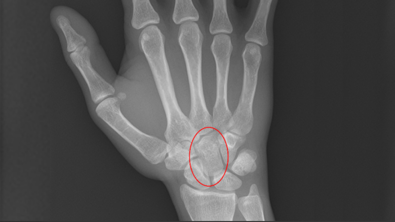 carpal bone injury