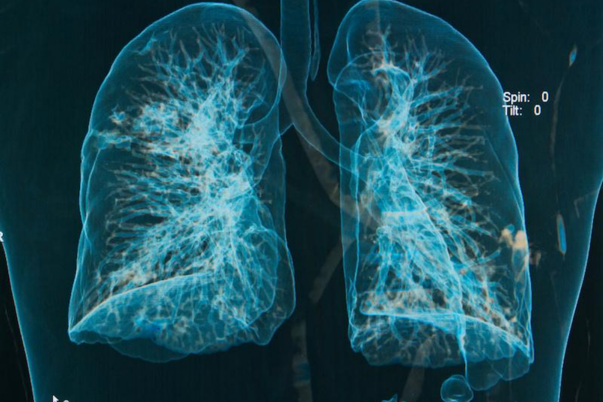Lung x-ray - silicosis
