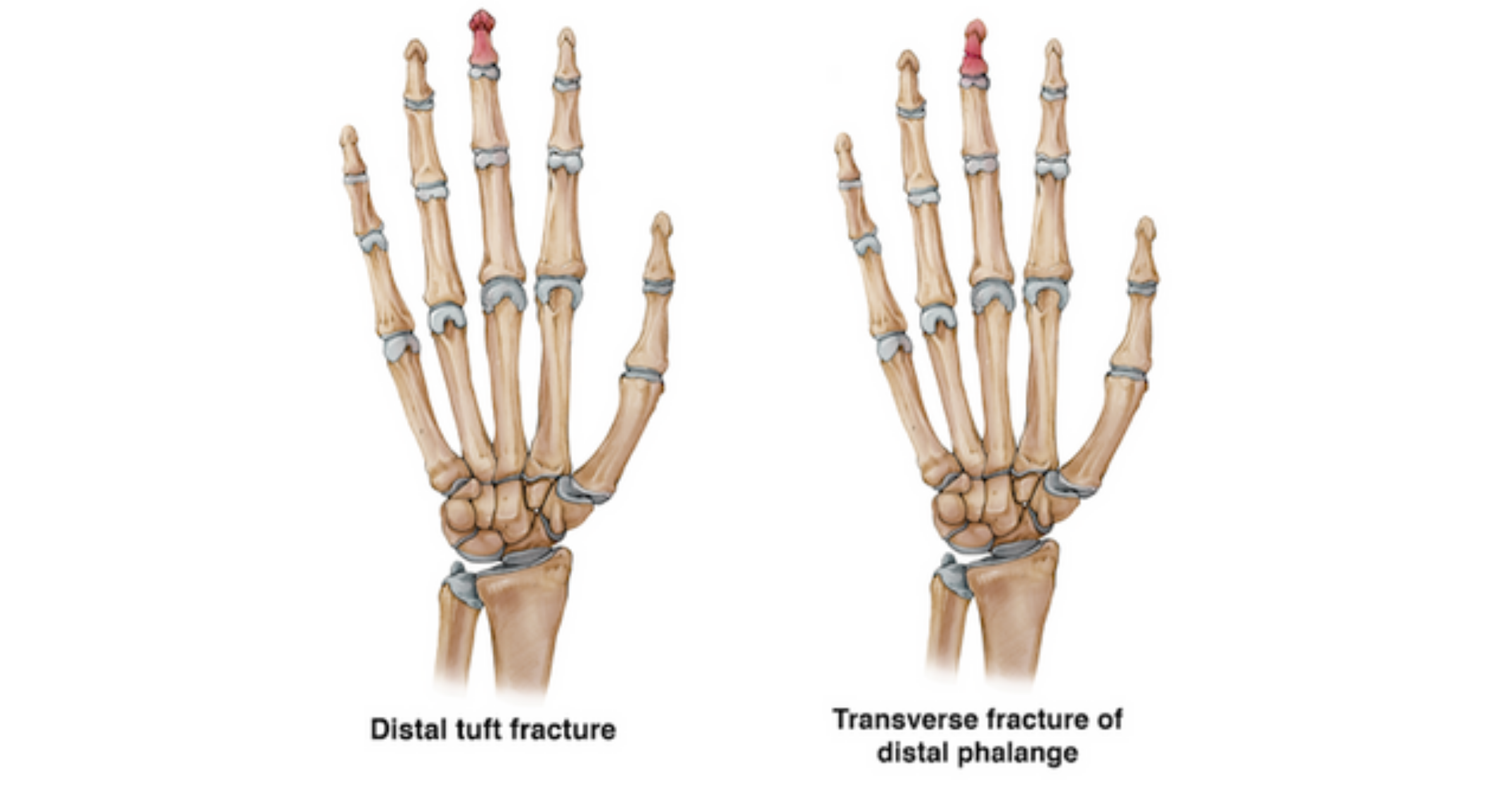 Anatomy of finger fracture for medico legal information