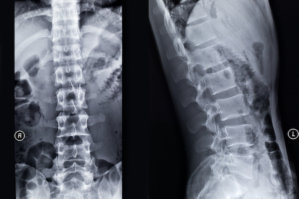 x-ray spinal cord for medico legal information