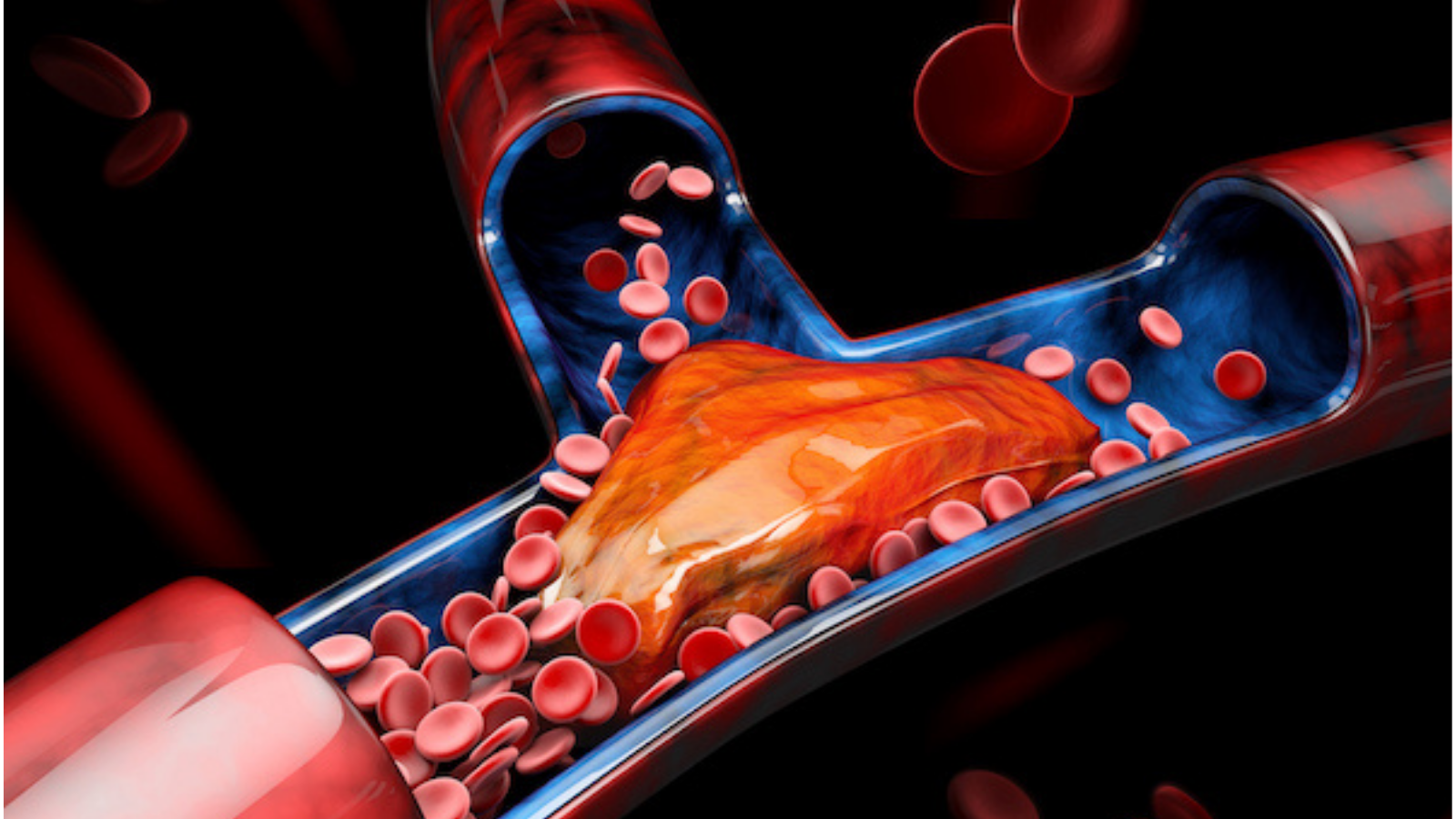 Blood Clots & Embolism: 3d Illustration of Deep Vein Thrombosis (DVT)