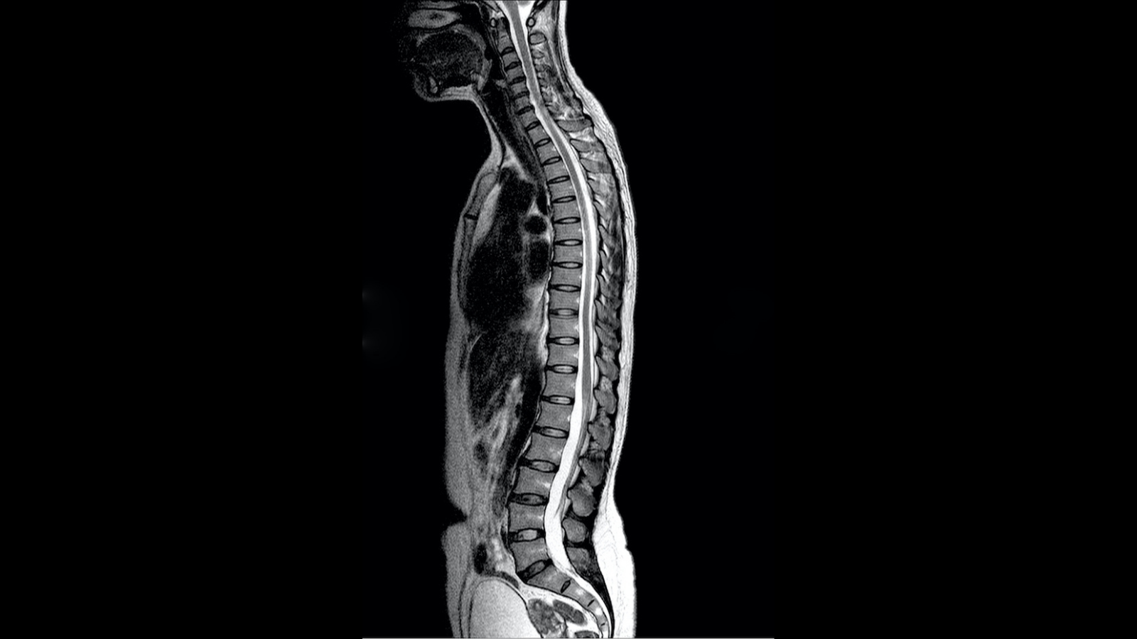Discogenic pain- Back pain without visible structural disc damage
