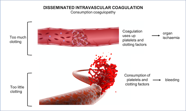 Disseminated intravascular coagulation