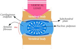 Intervertebral disc compressed by a vertical load