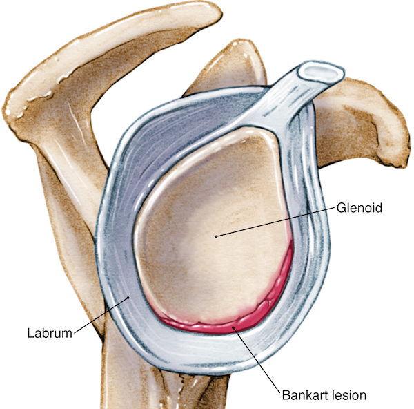 Bankart lesion at the antero-inferior portion of the glenoid 