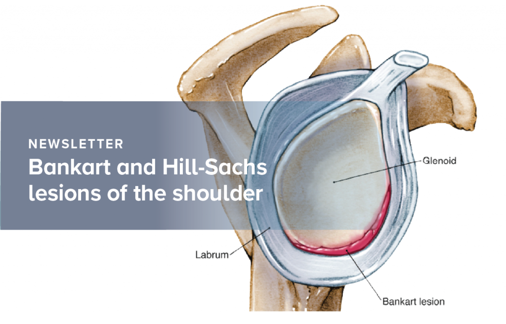 Bankart and Hill-Sachs lesions of the shoulder joint