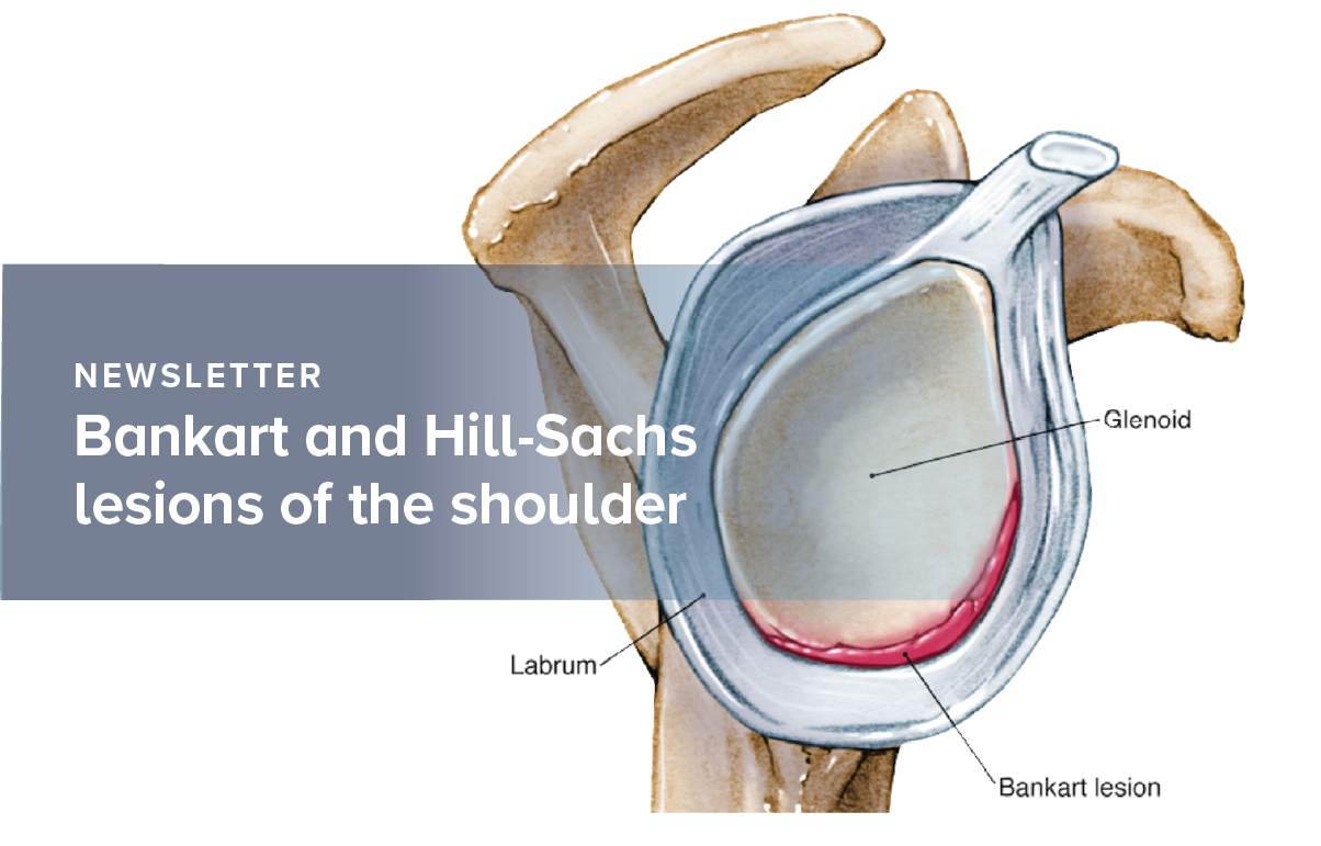 Bankart and Hill-Sachs lesions of the shoulder joint