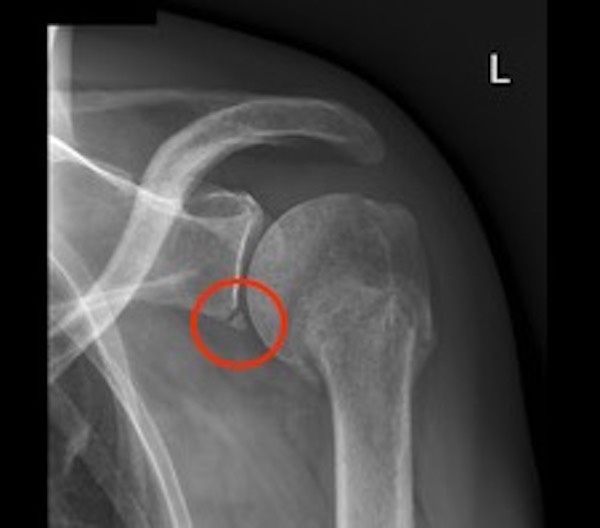 X-ray showing an osseous Bankart lesion at the inferior part of the glenoid fossa 