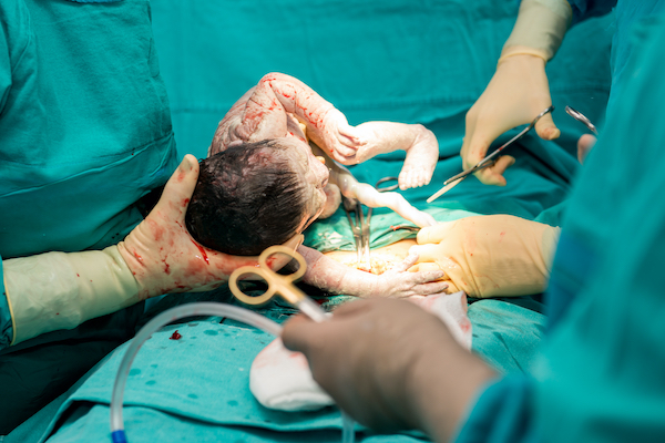 Despite medical evidence on the increased risks for the mother and baby, Caesarean sections are increasing in the US and elsewhere in the world 