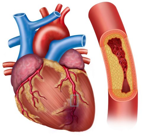 Broken heart syndrome: heart attack caused by blood clot