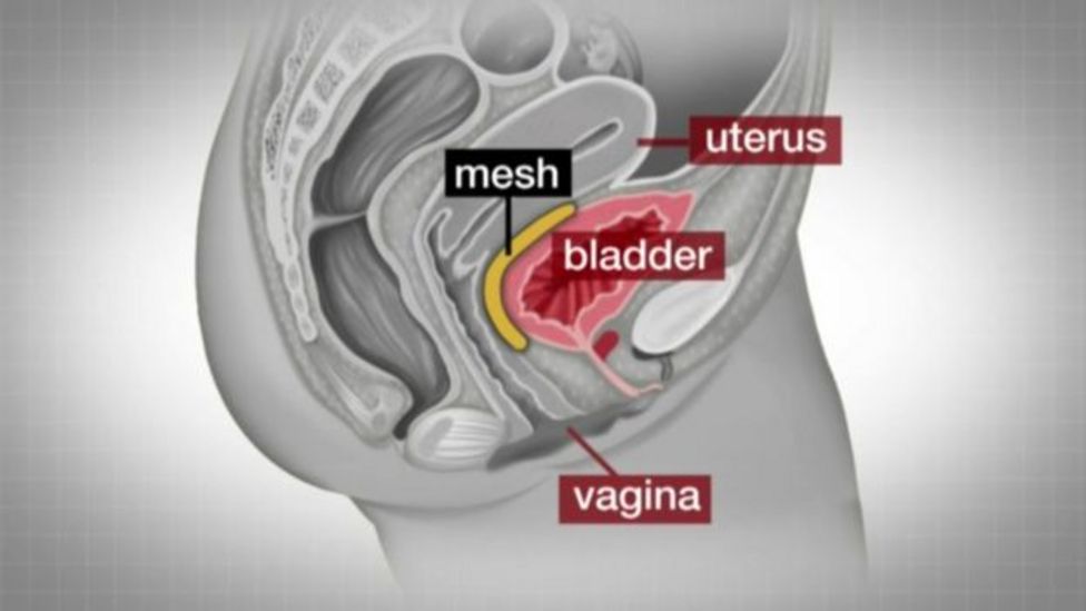 Diagram of the transvaginal vaginal mesh (yellow) positioned between the uterus and the bladder