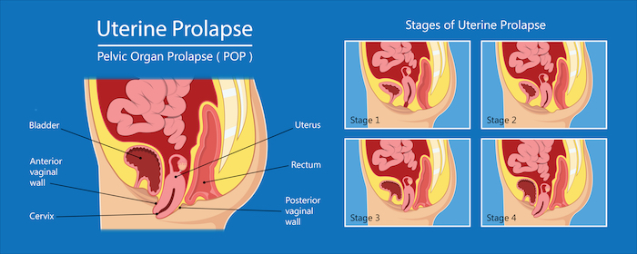 A diagram showing different stages of uterine prolapse 