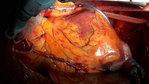 A freshly stitched heart showing a completed vessel graft following coronary bypass surgery.