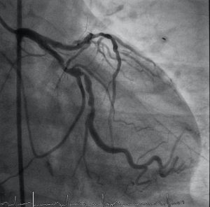 Coronary artery angiogram (CAG) was performed left coronary artery stenosis