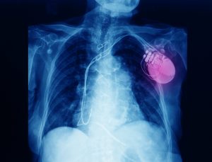 X-ray of a patient’s chest following the insertion of a pacemaker. Note the leads reaching the heart.