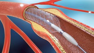 Diagram of a stent used to dilate an artery narrowed by a plaque.