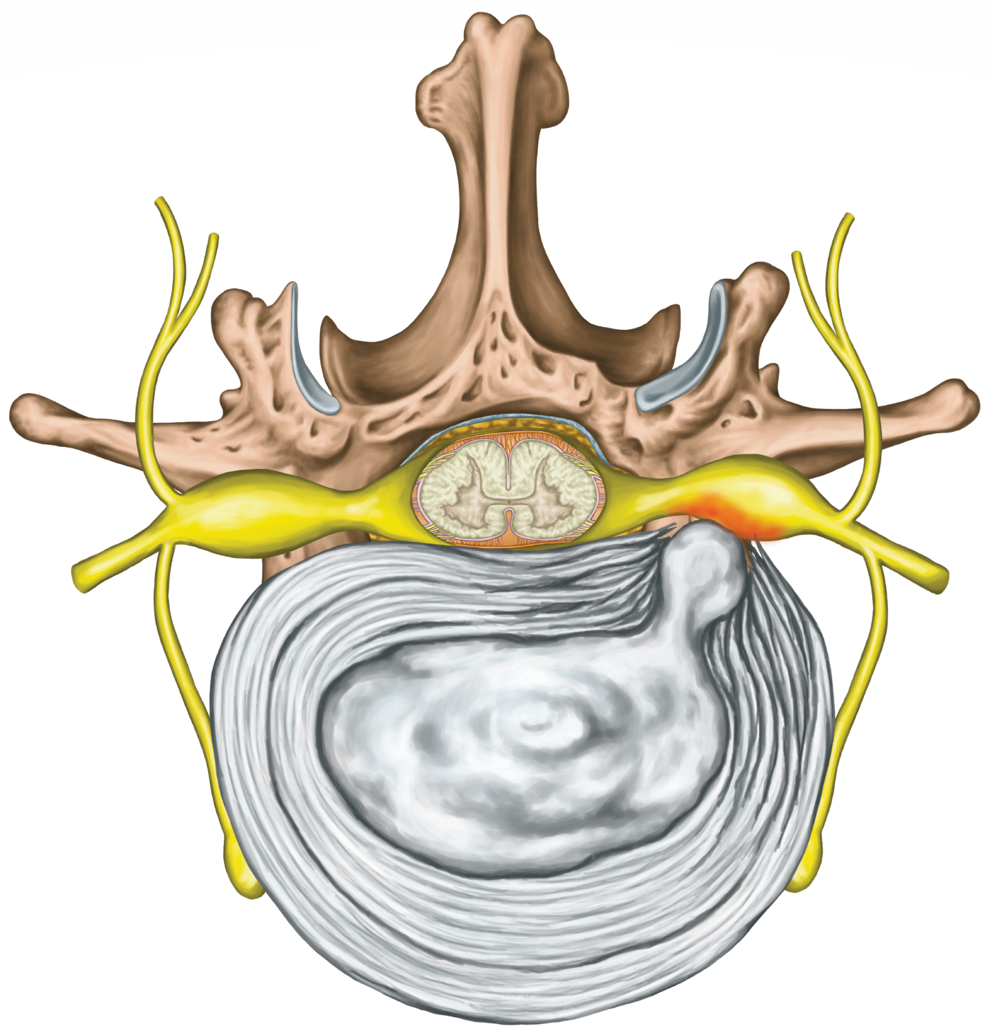 Disc Herniation Of The Spine | Lex Medicus