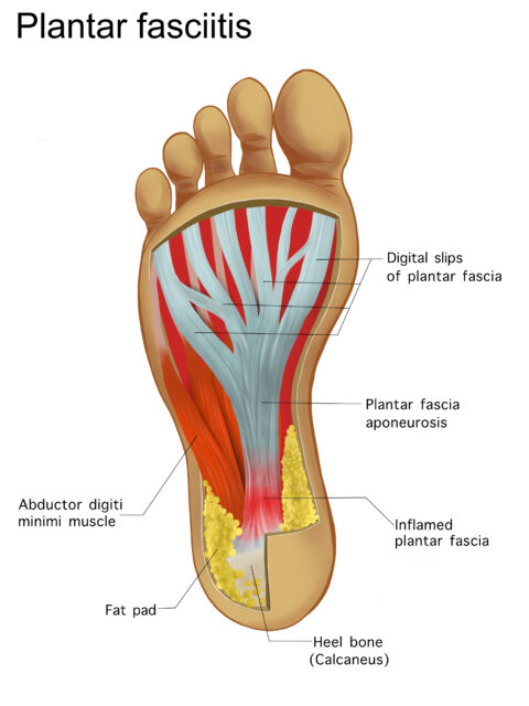 painful,plantar,fasciitis,ligament,feet,disorder,.,study,education,medical