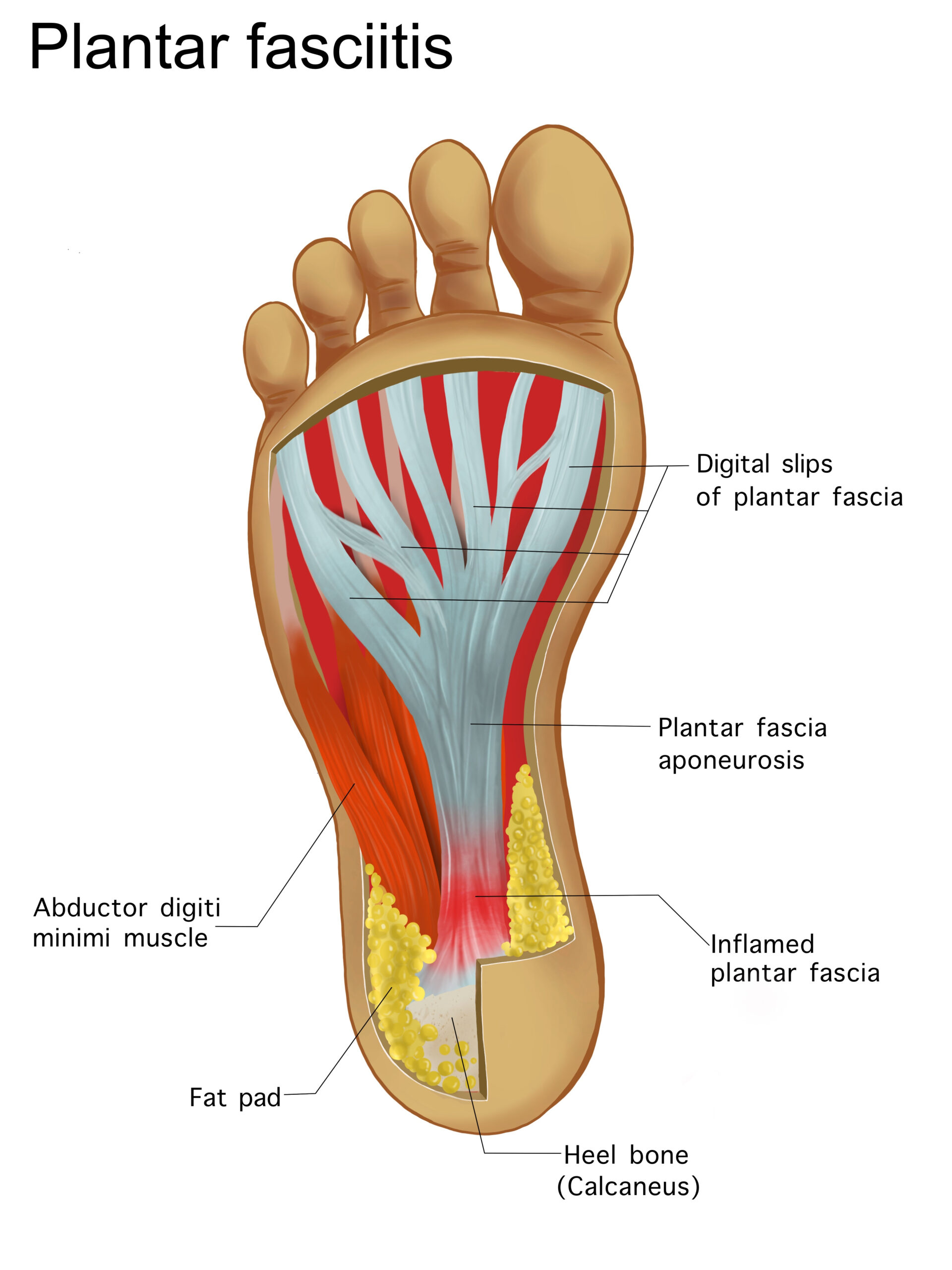 Plantar Heel Pain And The Rise Of Ugg Boot Foot